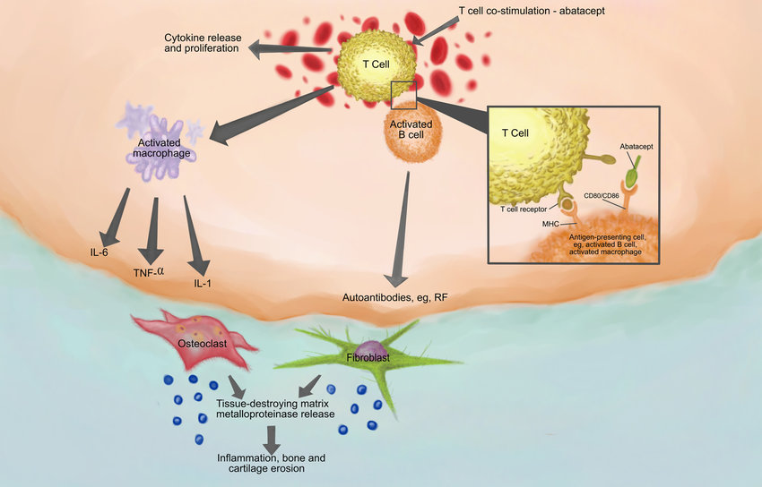 Rheumatoid arthritis